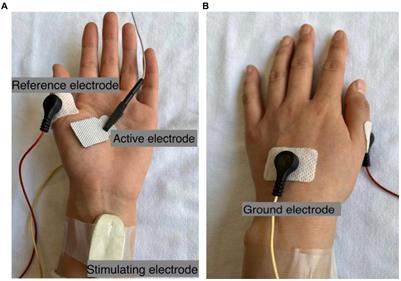 Effect of surface electrode recording area on compound muscle action potential scan processing for motor unit number estimation